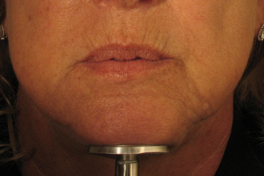 Lip wrinkles with Juvederm treatment