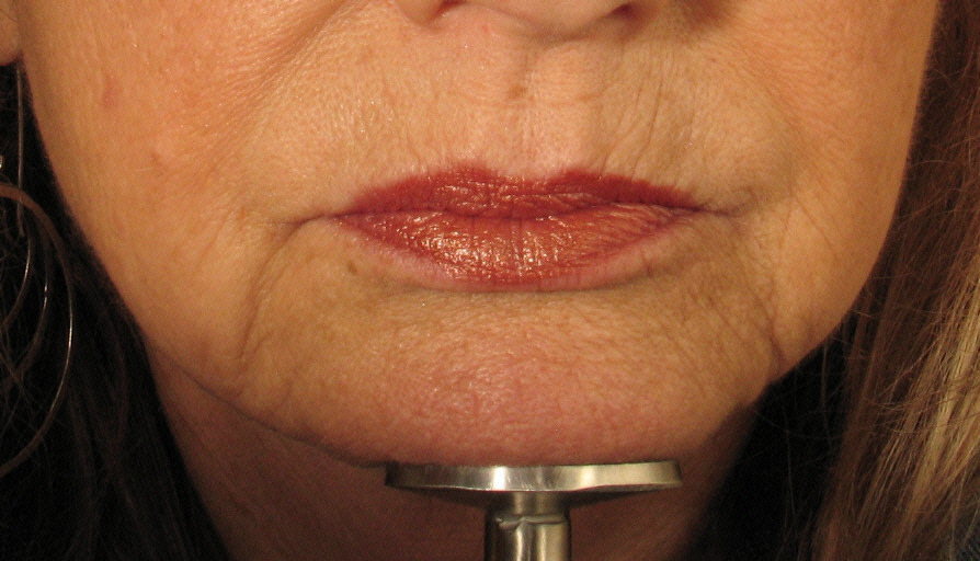 Juvederm Before