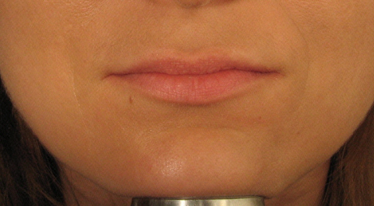  Juvederm Lips Before