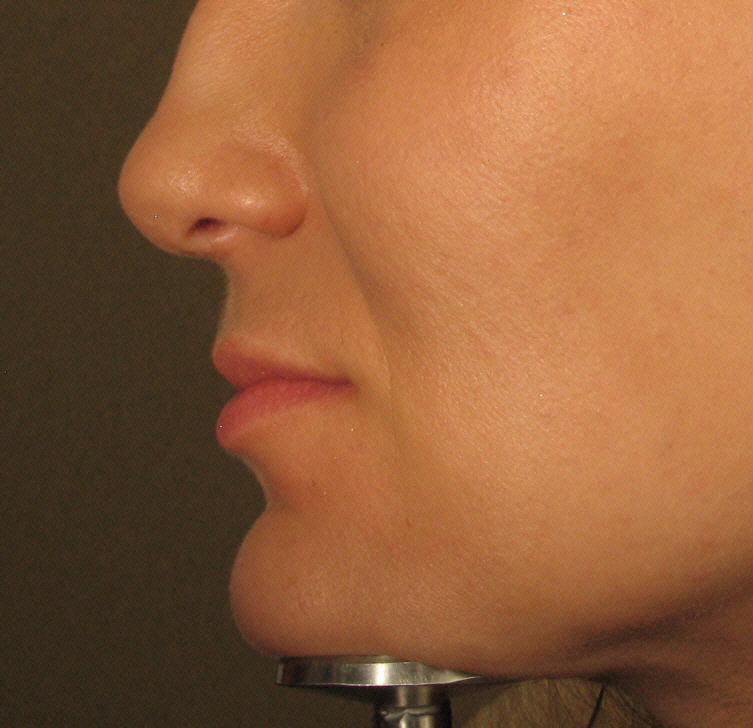 Juvederm Before