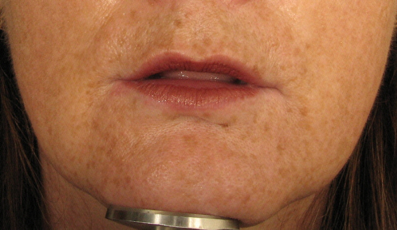 Make over with IPL, Botox and Radiesse Before