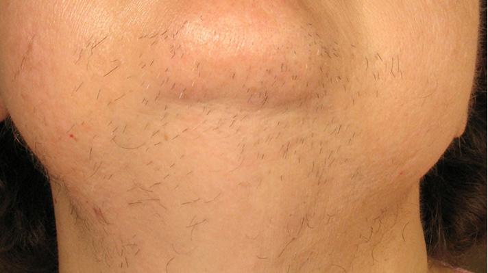 Laser Hair Removal Before