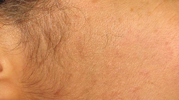 Laser Hair Removal before