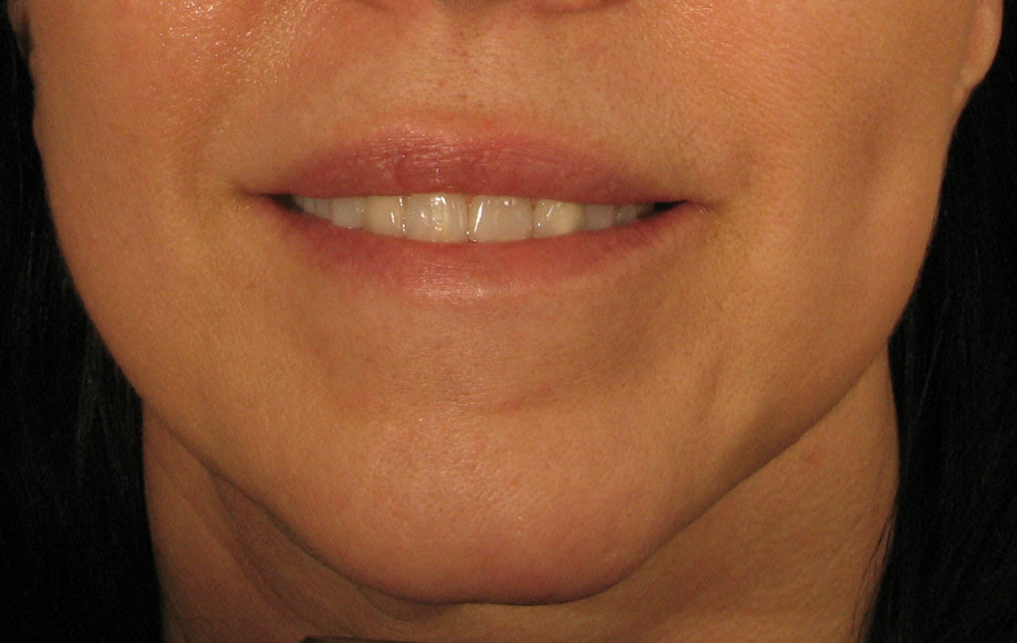 Make over with IPL, Botox and Radiesse After