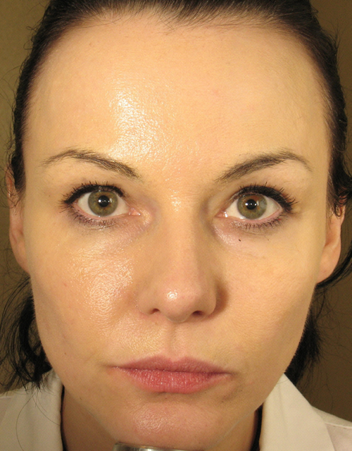 Make over with IPL, Botox and Radiesse After