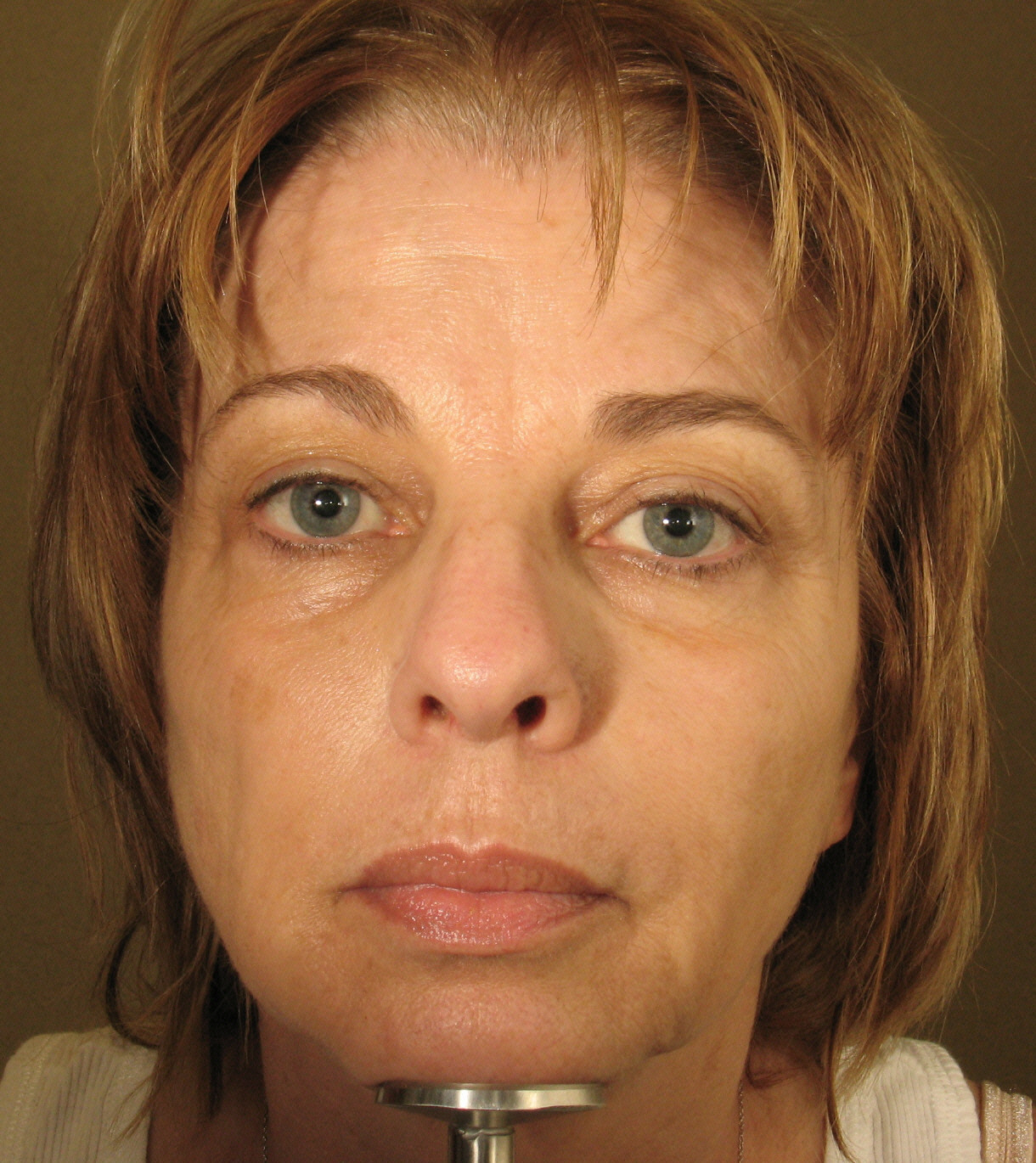 Make over with IPL, Botox and Radiesse Before