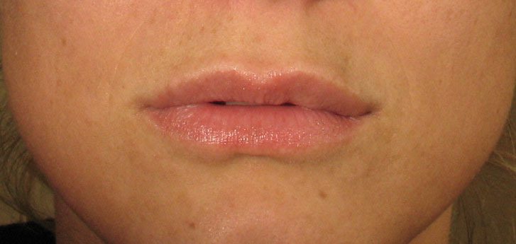 Lips after dermal fillers: restylane or juvederm