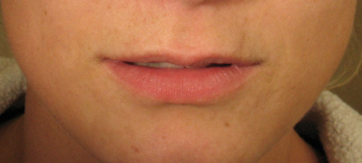 thin uneven lips before restylane or juvederm