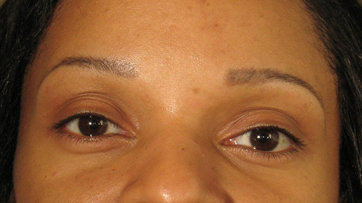 Before Restylane