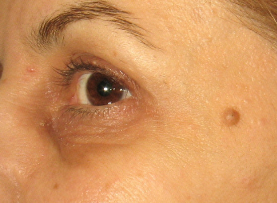 Before Restylane