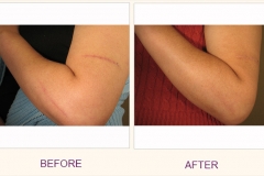 Scar Removal Pixel Treatment