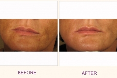 Pixel Skin Resurfacing