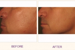 Skin Resurfacing Pixel