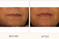 Restylane Lip Treatment