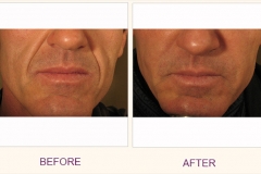 Perlane Treatment Frown Lines