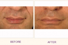 Restylane Treatment Frown Lines