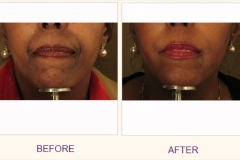Restylane Lip Treatment