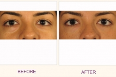 Perlane treatment