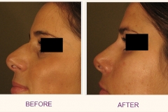 Perlane Cheek Treatment