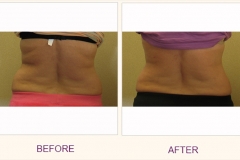 Body Contouring Lipodissolve/Cavi-Lipo