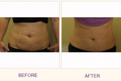 Body Contouring Lipodissolve/Cavi-Lipo