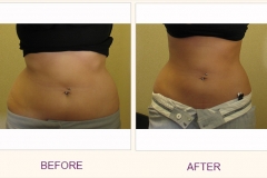 Body Contouring Lipodissolve/Cavi-Lipo