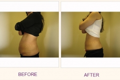 Body Contouring Lipodissolve/Cavi-Lipo