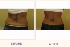 Body Contouring Lipodissolve/Cavi-Lipo