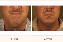 Body Contouring Lipodissolve/Cavi-Lipo
