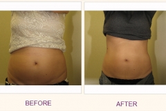Body Contouring Lipodissolve/Cavi-Lipo