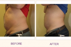 Body Contouring Lipodissolve/Cavi-Lipo
