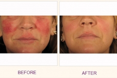 Rosacea Treatment-IPL