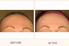 Pore reduction IPL