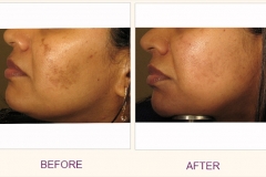 Wrinkle reduction with IPL