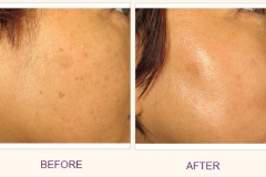 Intense Pulse Light (IPL) Treatment