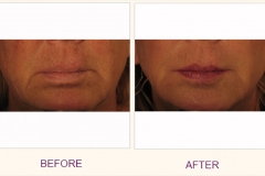 Juvederm Voluma Treatment