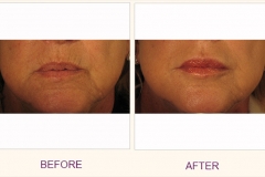 Juvederm Voluma Treatment