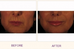 Juvederm Voluma Treatment