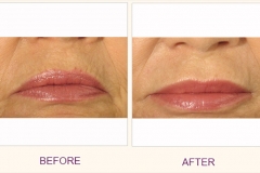 Juvederm Voluma Treatment