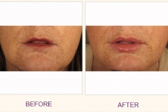 Juvederm Voluma Treatment