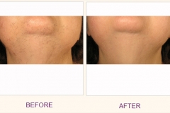 Laser Hair Removal beard