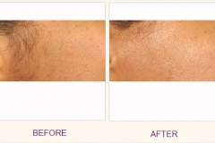 Laser Hair Removal Side burns
