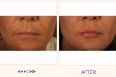 Voluma Lip Enhancement