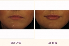Lip plumping Perlane