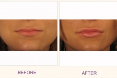 Lip Enhancement