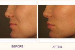 Lip augmentation