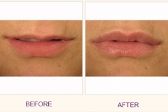 Restylane Lip Plumping