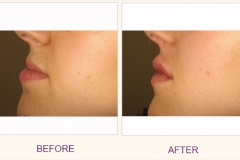 Lip Plumping