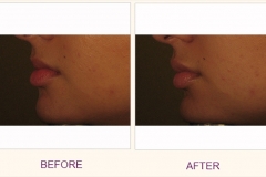 Lip Enhancement Restylane