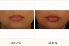 Lip augmentation Juvederm